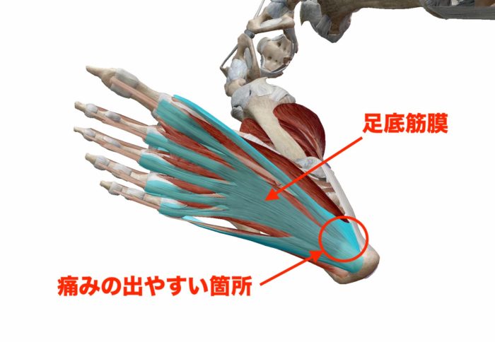 足底筋膜炎で痛みの出やすい箇所は、かかとの裏から内側です。